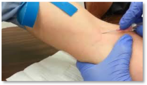 sticking needle in vein